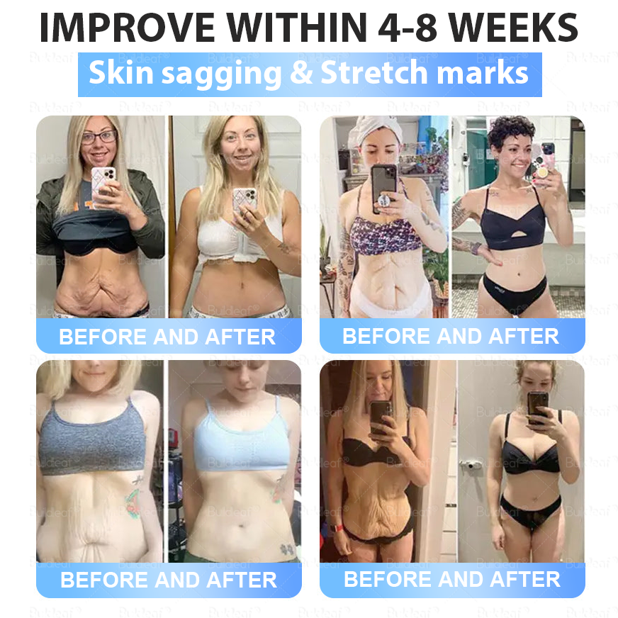 Clinically Proven|Official Store | Buildleaf® Tirzepatide Nano Microneedle Patch with Collagen & Matrixyl 3000 丨Targets Obesity, Loose Skin, High Blood Pressure, Diabetes, Fatty Liver, Joint Pain, Brain Fog, Low Energy, Body Aches, and More