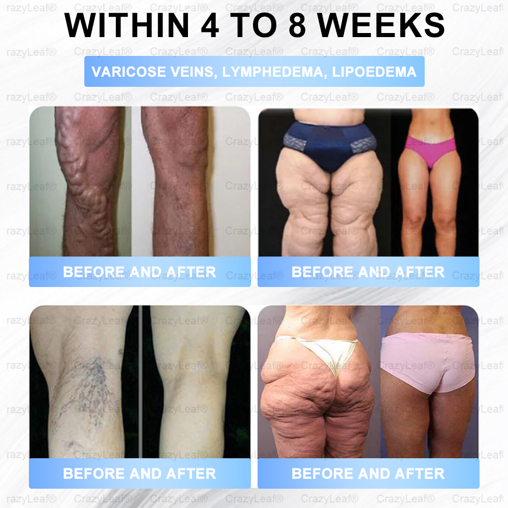 Clinically Proven|Official Store | Buildleaf® Tirzepatide Nano Microneedle Patch with Collagen & Matrixyl 3000 丨Targets Obesity, Loose Skin, High Blood Pressure, Diabetes, Fatty Liver, Joint Pain, Brain Fog, Low Energy, Body Aches, and More