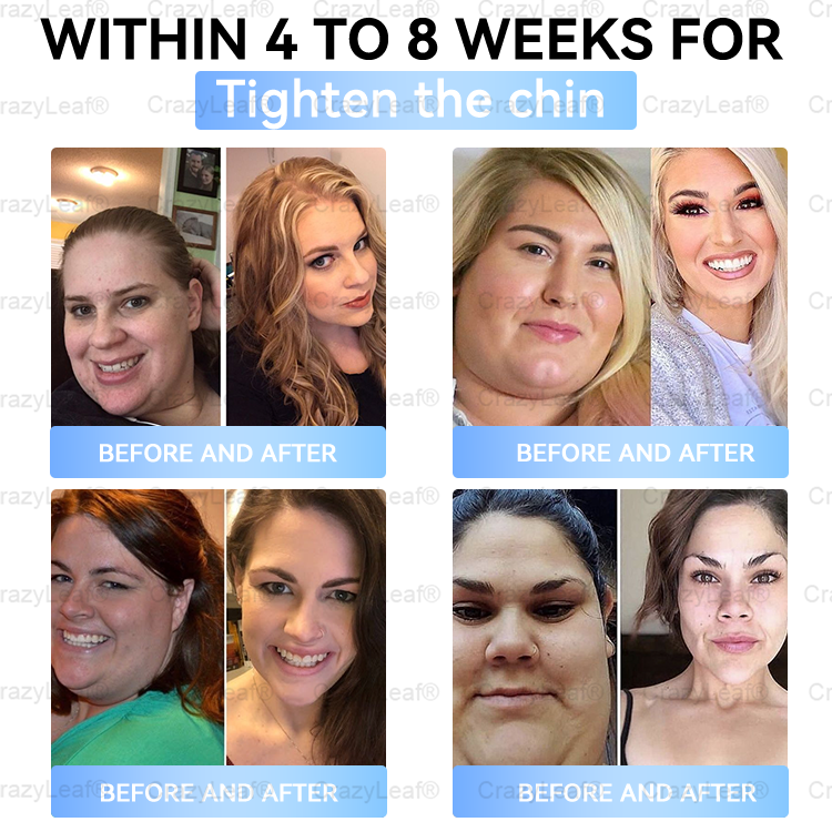 Clinically Proven|Official Store | Buildleaf® Tirzepatide Nano Microneedle Patch with Collagen & Matrixyl 3000 丨Targets Obesity, Loose Skin, High Blood Pressure, Diabetes, Fatty Liver, Joint Pain, Brain Fog, Low Energy, Body Aches, and More