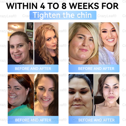 Clinically Proven|Official Store | Buildleaf® Tirzepatide Nano Microneedle Patch with Collagen & Matrixyl 3000 丨Targets Obesity, Loose Skin, High Blood Pressure, Diabetes, Fatty Liver, Joint Pain, Brain Fog, Low Energy, Body Aches, and More