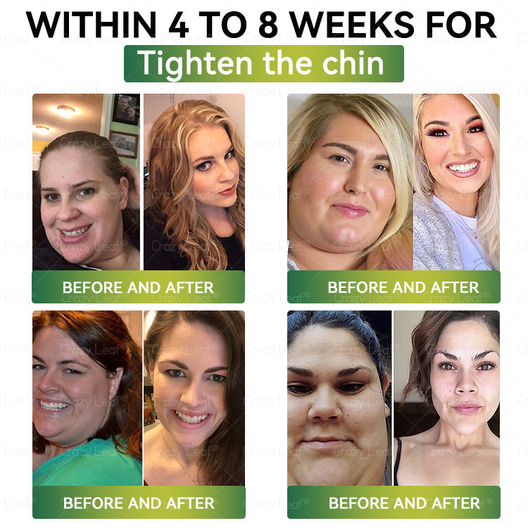 Clinically Proven|Official Store | CrazyLeaf® SMGT-GLP-1 Nano Microneedle Patch with Collagen & Matrixyl 3000 丨Targets Obesity, Loose Skin, High Blood Pressure, Diabetes, Fatty Liver, Joint Pain, Brain Fog, Low Energy, Body Aches, and More